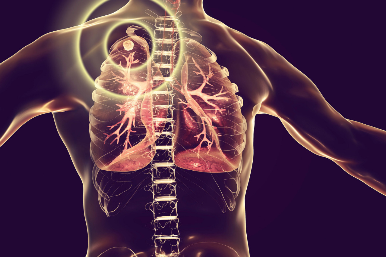 Extrapulmonary TB : टीबी का काल बनेंगे 300 प्रशिक्षित डॉक्टर 1 टीबी का काल बनेंगे 300 प्रशिक्षित डॉक्टर