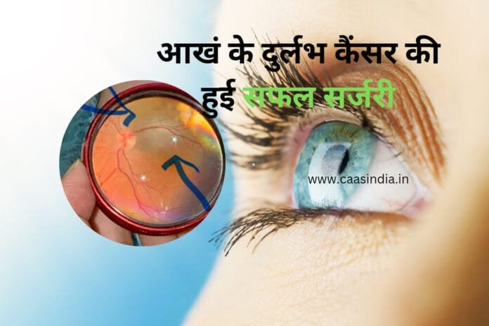 Gurugram News : 'प्लाक ब्रैकीथेरेपी' से आखं के दुर्लभ कैंसर की हुई सफल सर्जरी 