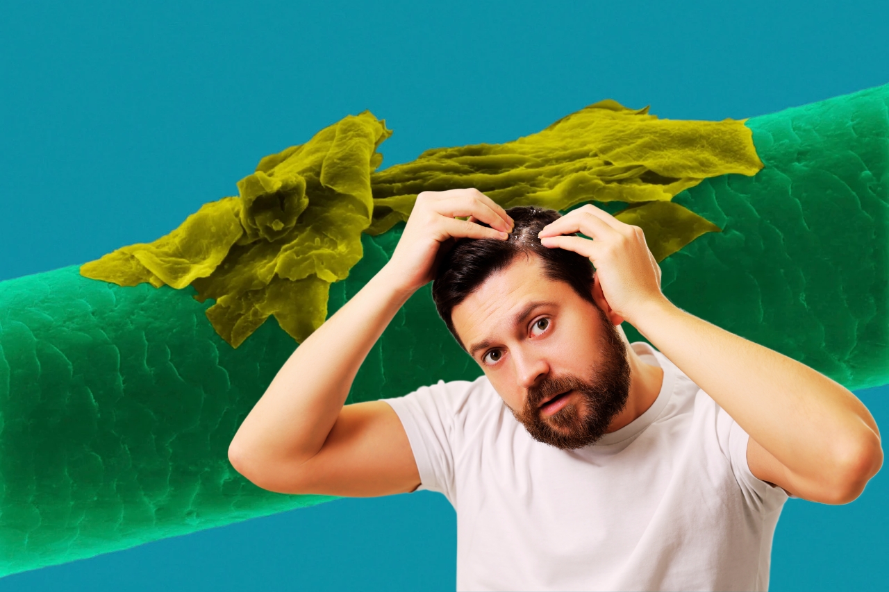 Dandruff से छुटकारा पाएं, अपने बालों को ऐसे बचाएं 1 Dandruff से छुटकारा पाएं, अपने बालों को ऐसे बचाएं