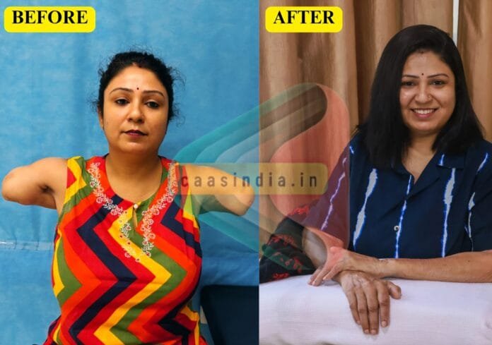 Faridabad : Double Hand transplant कर रिसर्च स्कॉलर को दिया नया जीवन