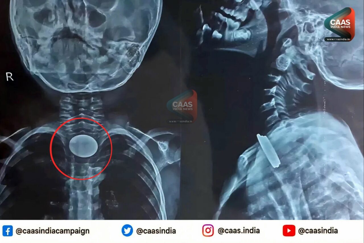 BSAH Coin Ingestion Child: खेल-खेल में निगल लिए 3 सिक्के, एसोफैगोस्कापी से बची जान 2 BSAH Coin Ingestion Child: खेल-खेल में निगल लिए 3 सिक्के, एसोफैगोस्कापी से बची जान